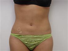 Liposuction & Lipoetching Gallery - Heavenly Plastic Surgery