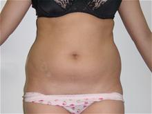 Liposuction Before and After Pictures Case 176, Los Angeles, CA