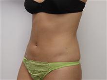 Liposuction After Photo by Lane Smith, MD; Las Vegas, NV - Case 27048
