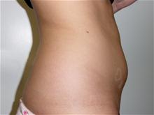 Liposuction Before Photo by Lane Smith, MD; Las Vegas, NV - Case 27048