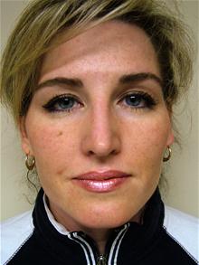 Rhinoplasty After Photo by Lane Smith, MD; Las Vegas, NV - Case 27049