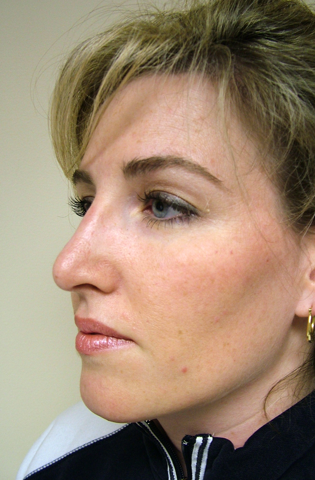 Rhinoplasty Before and After Photos by Lane Smith, MD; Las Vegas, NV Case 27049 ASPS
