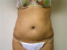 Tummy Tuck After Photo by Lane Smith, MD; Las Vegas, NV - Case 27051
