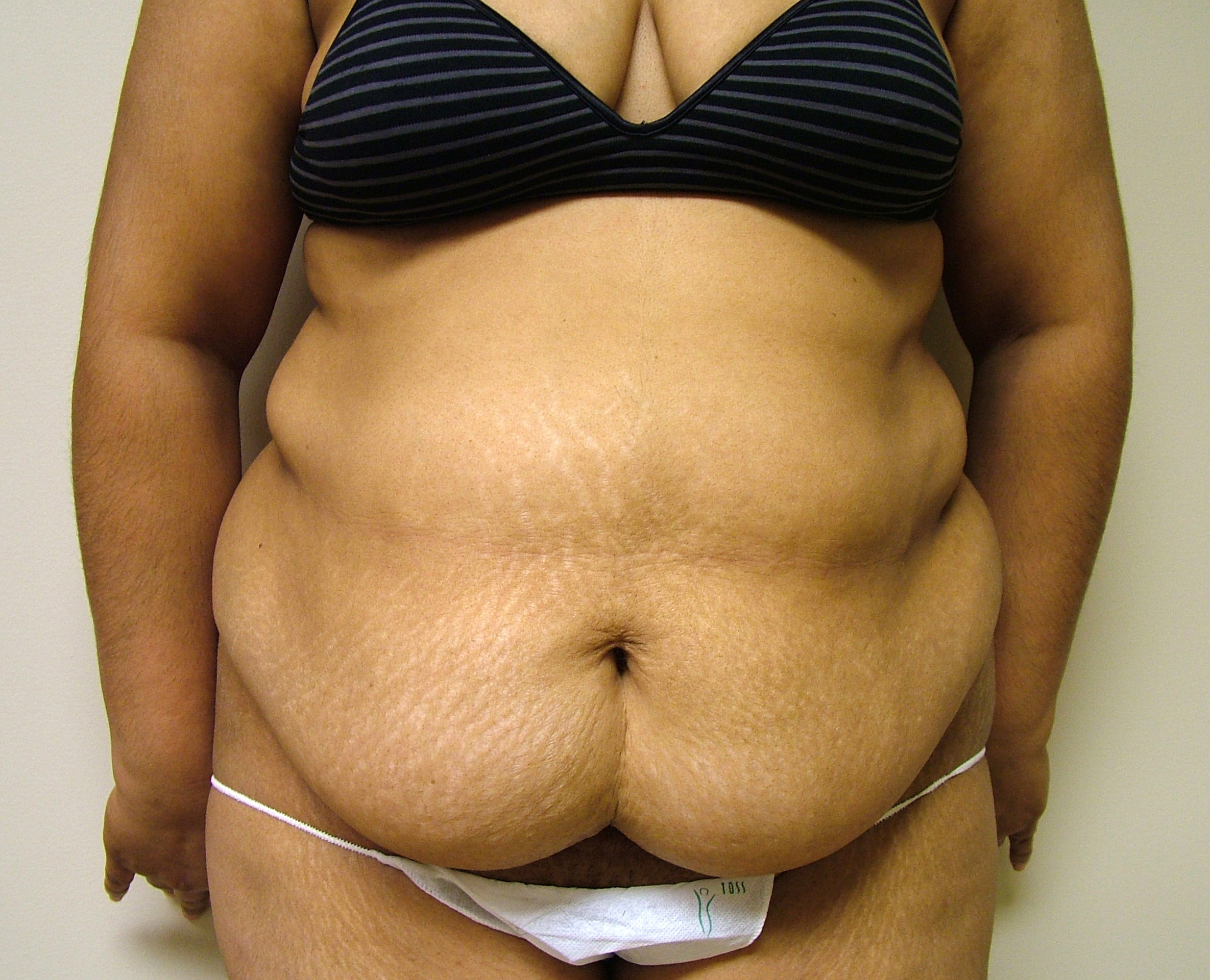 Tummy Tuck Before and After Photos by Lane Smith, MD; Las Vegas