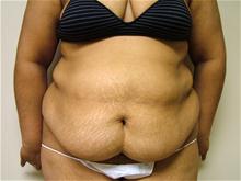 Tummy Tuck Before Photo by Lane Smith, MD; Las Vegas, NV - Case 27051