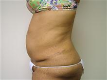 Tummy Tuck After Photo by Lane Smith, MD; Las Vegas, NV - Case 27051