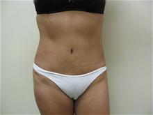 Tummy Tuck After Photo by Lane Smith, MD; Las Vegas, NV - Case 27052