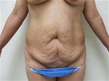 Tummy Tuck Before Photo by Lane Smith, MD; Las Vegas, NV - Case 27052