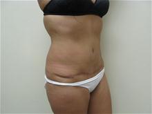 Tummy Tuck After Photo by Lane Smith, MD; Las Vegas, NV - Case 27052