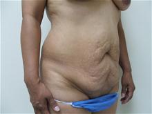 Tummy Tuck Before Photo by Lane Smith, MD; Las Vegas, NV - Case 27052