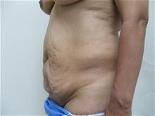 Tummy Tuck Before Photo by Lane Smith, MD; Las Vegas, NV - Case 27052