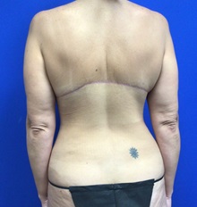 Body Lift After Photo by Roxanne Sylora, MD; Celebration, FL - Case 50607