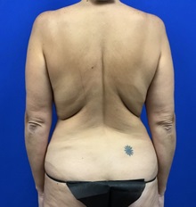 Body Lift Before Photo by Roxanne Sylora, MD; Celebration, FL - Case 50607