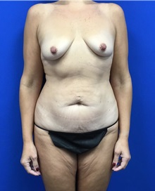 Body Lift Before Photo by Roxanne Sylora, MD; Celebration, FL - Case 50607