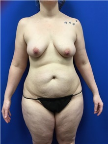 Tummy Tuck Before Photo by Roxanne Sylora, MD; Celebration, FL - Case 50608