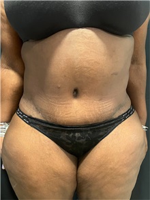 Tummy Tuck After Photo by M. Zakir Sabry, MD; ,  - Case 50368
