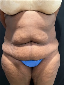 Tummy Tuck Before Photo by M. Zakir Sabry, MD; ,  - Case 50368