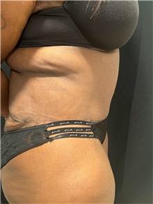 Tummy Tuck After Photo by M. Zakir Sabry, MD; ,  - Case 50368