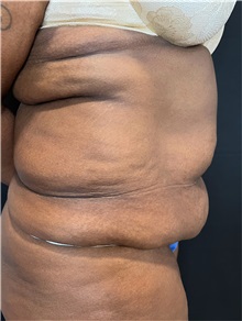 Tummy Tuck Before Photo by M. Zakir Sabry, MD; ,  - Case 50368