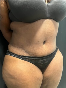 Tummy Tuck After Photo by M. Zakir Sabry, MD; ,  - Case 50368