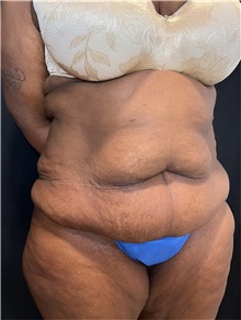 Tummy Tuck Before Photo by M. Zakir Sabry, MD; ,  - Case 50368