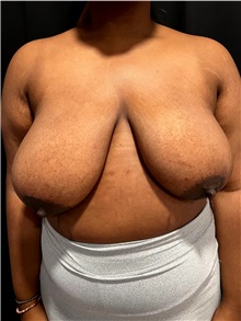 Breast Reduction Before Photo by M. Zakir Sabry, MD; ,  - Case 50370