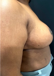 Breast Reduction After Photo by M. Zakir Sabry, MD; ,  - Case 50370