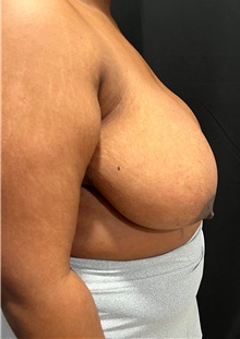 Breast Reduction Before Photo by M. Zakir Sabry, MD; ,  - Case 50370