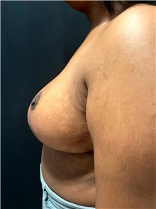 Breast Reduction After Photo by M. Zakir Sabry, MD; ,  - Case 50370