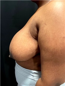 Breast Reduction Before Photo by M. Zakir Sabry, MD; ,  - Case 50370
