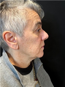 Body Lift Before Photo by M. Zakir Sabry, MD; ,  - Case 50371