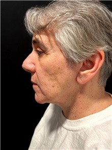 Body Lift After Photo by M. Zakir Sabry, MD; ,  - Case 50371