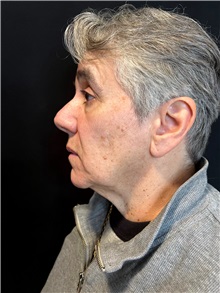 Body Lift Before Photo by M. Zakir Sabry, MD; ,  - Case 50371