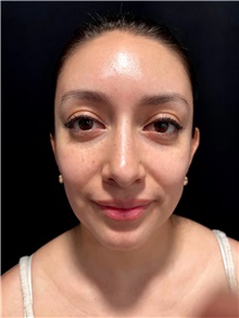 Deviated Septum Correction After Photo by M. Zakir Sabry, MD; ,  - Case 50372