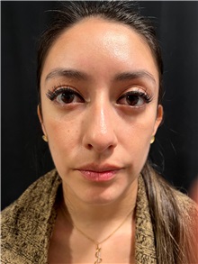 Deviated Septum Correction Before Photo by M. Zakir Sabry, MD; ,  - Case 50372