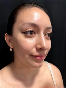 Deviated Septum Correction After Photo by M. Zakir Sabry, MD; ,  - Case 50372