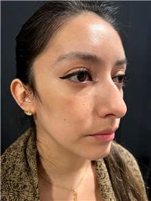 Deviated Septum Correction Before Photo by M. Zakir Sabry, MD; ,  - Case 50372