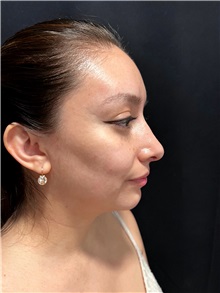 Deviated Septum Correction After Photo by M. Zakir Sabry, MD; ,  - Case 50372