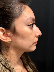 Deviated Septum Correction Before Photo by M. Zakir Sabry, MD; ,  - Case 50372