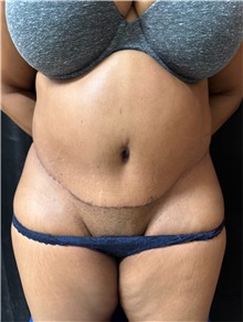 Tummy Tuck After Photo by M. Zakir Sabry, MD; ,  - Case 50386