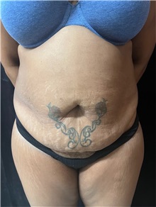 Tummy Tuck Before Photo by M. Zakir Sabry, MD; ,  - Case 50386