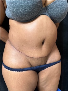 Tummy Tuck After Photo by M. Zakir Sabry, MD; ,  - Case 50386