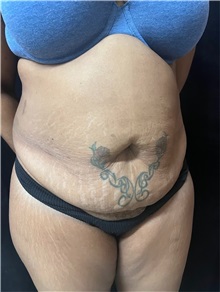Tummy Tuck Before Photo by M. Zakir Sabry, MD; ,  - Case 50386