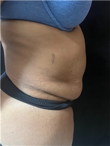 Tummy Tuck Before Photo by M. Zakir Sabry, MD; ,  - Case 50386