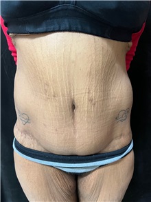 Tummy Tuck After Photo by M. Zakir Sabry, MD; ,  - Case 50385