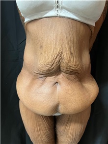 Tummy Tuck Before Photo by M. Zakir Sabry, MD; ,  - Case 50385