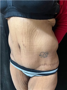 Tummy Tuck After Photo by M. Zakir Sabry, MD; ,  - Case 50385
