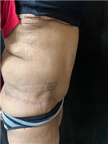 Tummy Tuck After Photo by M. Zakir Sabry, MD; ,  - Case 50385