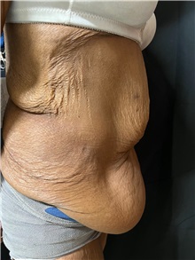 Tummy Tuck Before Photo by M. Zakir Sabry, MD; ,  - Case 50385