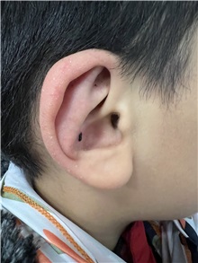 Ear Surgery After Photo by M. Zakir Sabry, MD; New York, NY - Case 50787